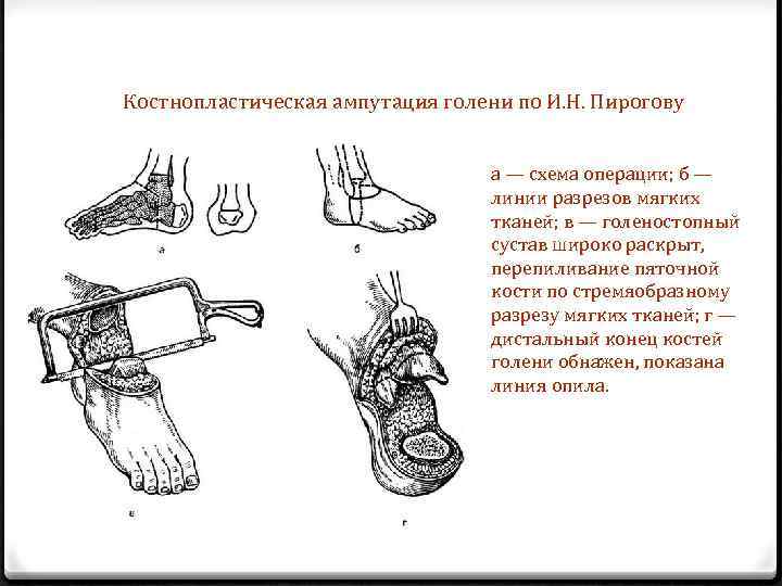 Костнопластическая ампутация голени по И. Н. Пирогову а — схема операции; б — линии