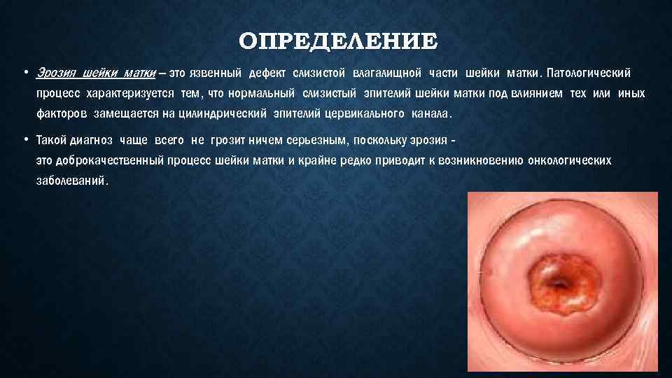 ОПРЕДЕЛЕНИЕ • Эрозия шейки матки – это язвенный дефект слизистой влагалищной части шейки матки.