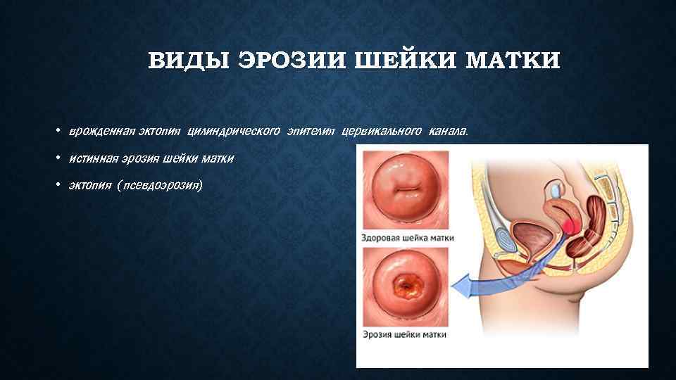 Эктопия матки. Врожденная эрозия шейки. Эктопия эпителия шейка матки. Эрозия и эктопия шейки матки. Эктопия (псевдоэрозия) шейки матки.