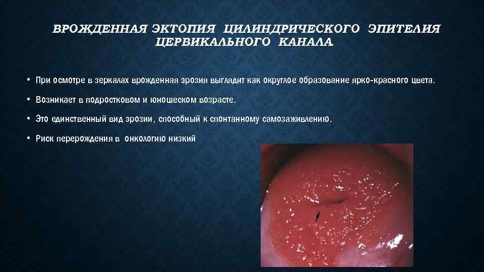 ВРОЖДЕННАЯ ЭКТОПИЯ ЦИЛИНДРИЧЕСКОГО ЭПИТЕЛИЯ ЦЕРВИКАЛЬНОГО КАНАЛА. • При осмотре в зеркалах врожденная эрозия выглядит