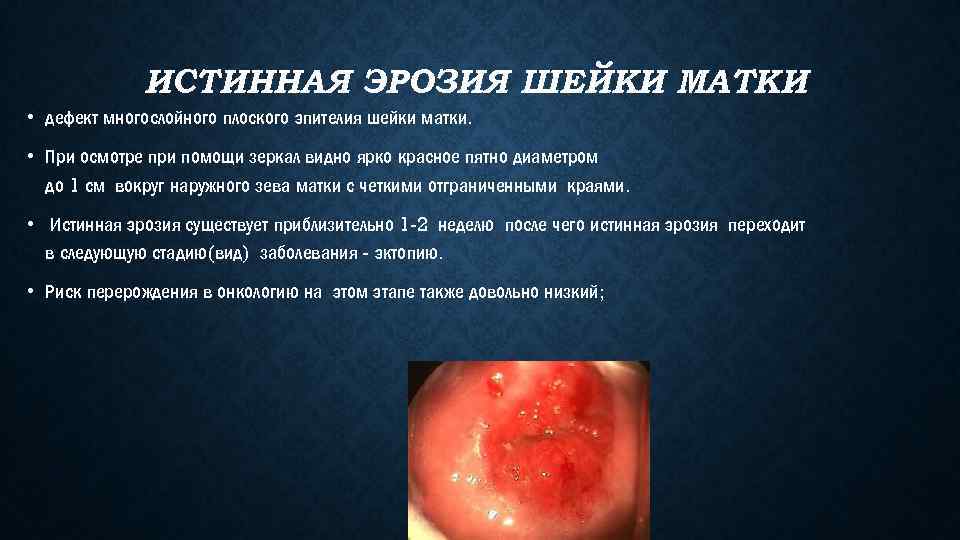 ИСТИННАЯ ЭРОЗИЯ ШЕЙКИ МАТКИ • дефект многослойного плоского эпителия шейки матки. • При осмотре