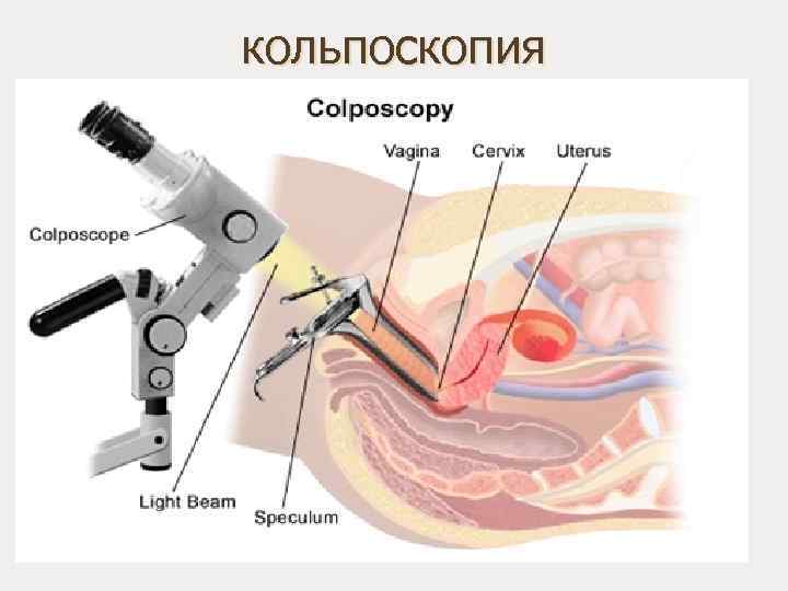 кольпоскопия 