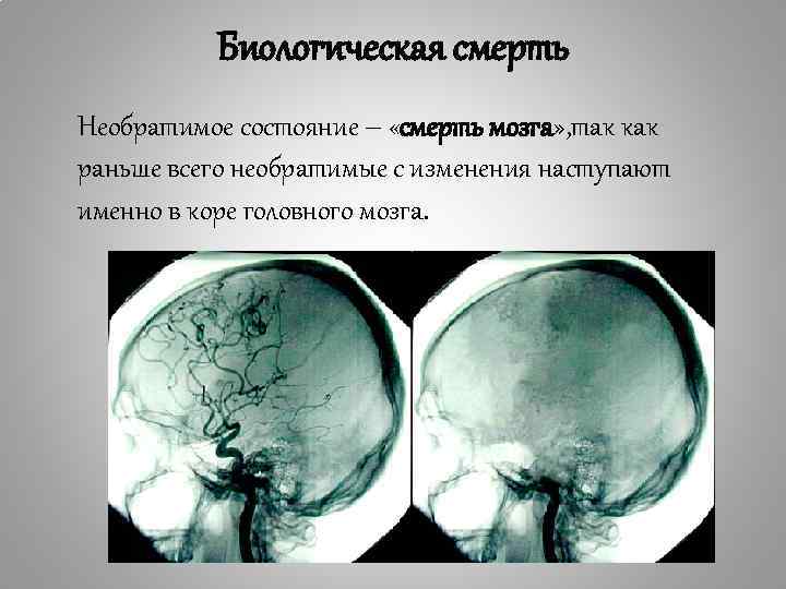 Биологическая смерть Необратимое состояние – «смерть мозга» , так как раньше всего необратимые с