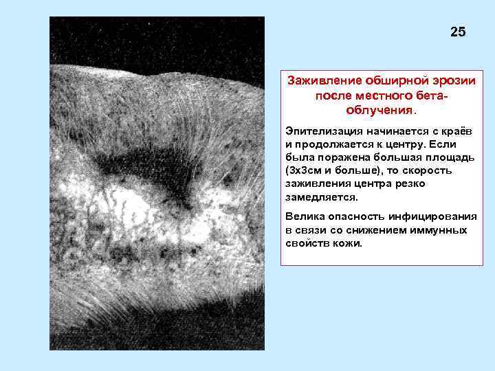 25 Заживление обширной эрозии после местного бетаоблучения. Эпителизация начинается с краёв и продолжается к