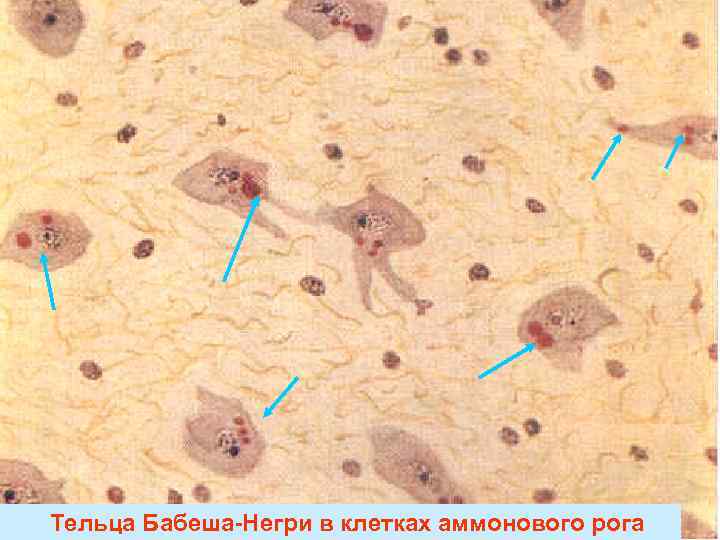 Тельца Бабеша-Негри в клетках аммонового рога 