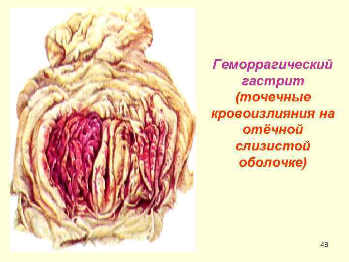 Геморрагический гастрит (точечные кровоизлияния на отёчной слизистой оболочке) 48 