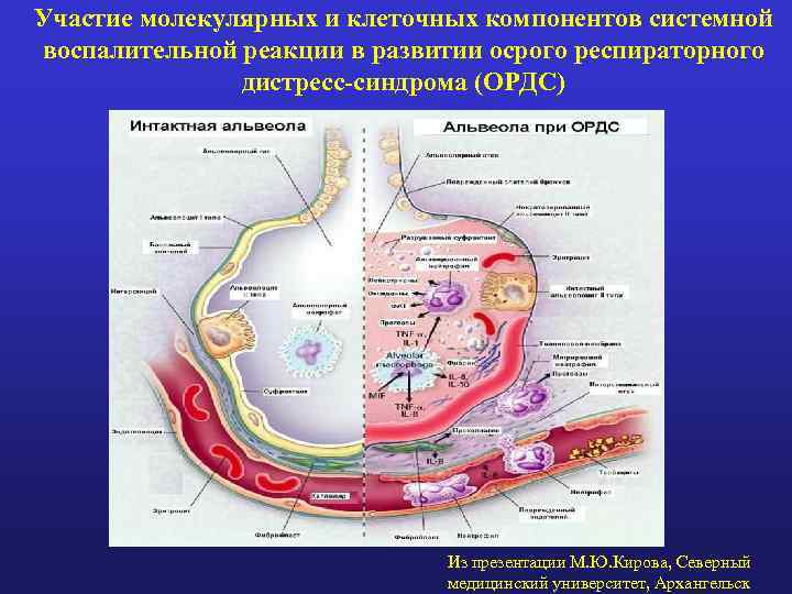 Участие молекулярных и клеточных компонентов системной воспалительной реакции в развитии осрого респираторного дистресс-синдрома (ОРДС)