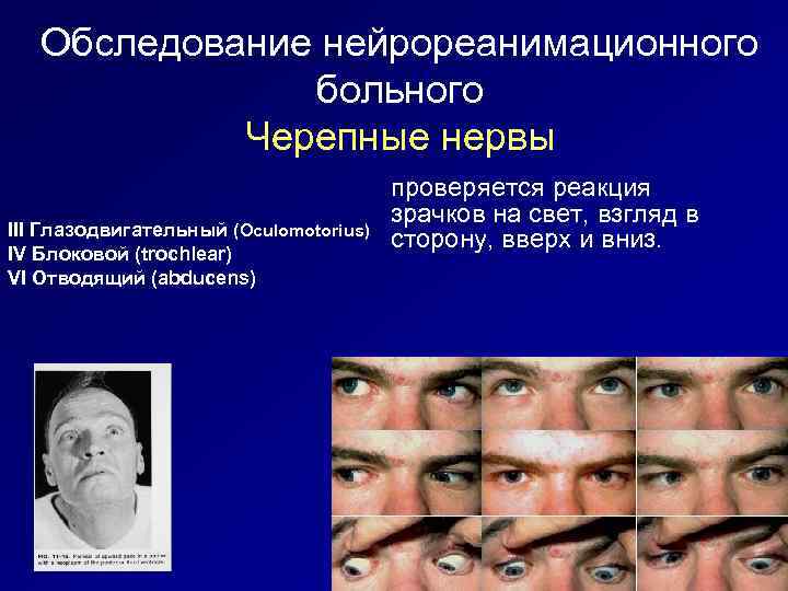 Обследование нейрореанимационного больного Черепные нервы III Глазодвигательный (Oculomotorius) IV Блоковой (trochlear) VI Отводящий (abducens)