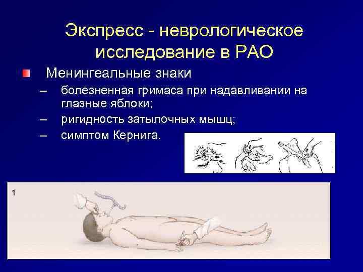 Экспресс - неврологическое исследование в РАО Менингеальные знаки – – – болезненная гримаса при