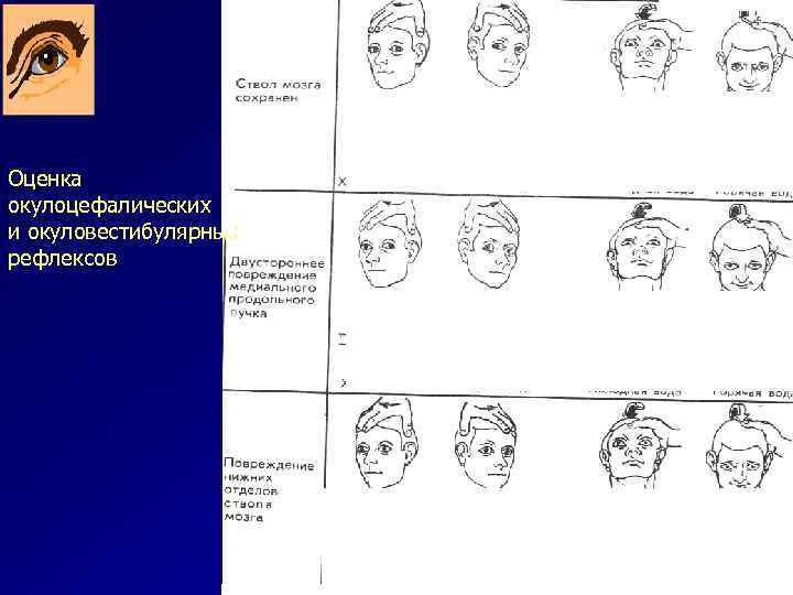 Оценка окулоцефалических и окуловестибулярных рефлексов 