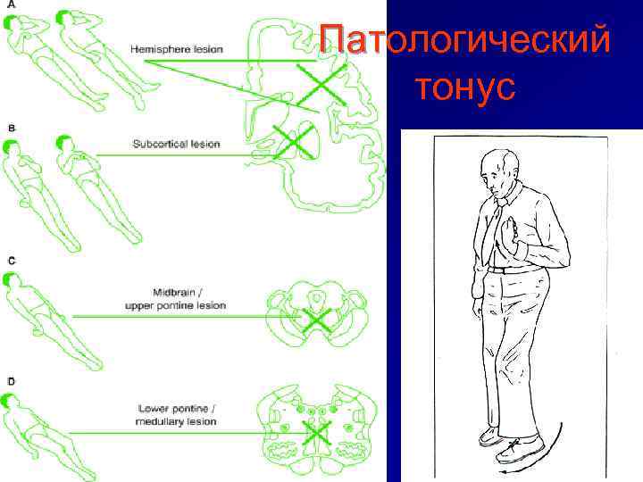 Патологический тонус 