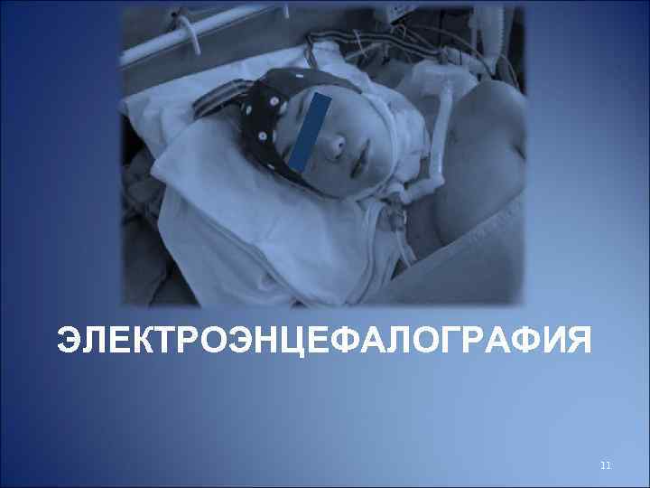 ЭЛЕКТРОЭНЦЕФАЛОГРАФИЯ 11 