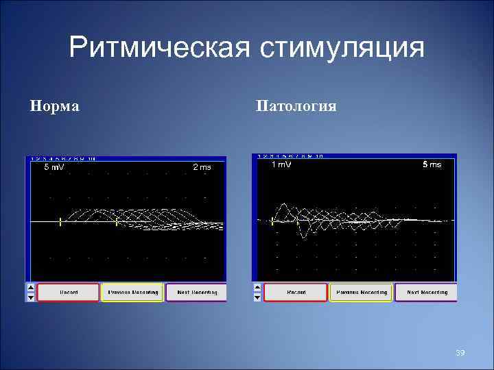 Ритмическая стимуляция Норма Патология 39 
