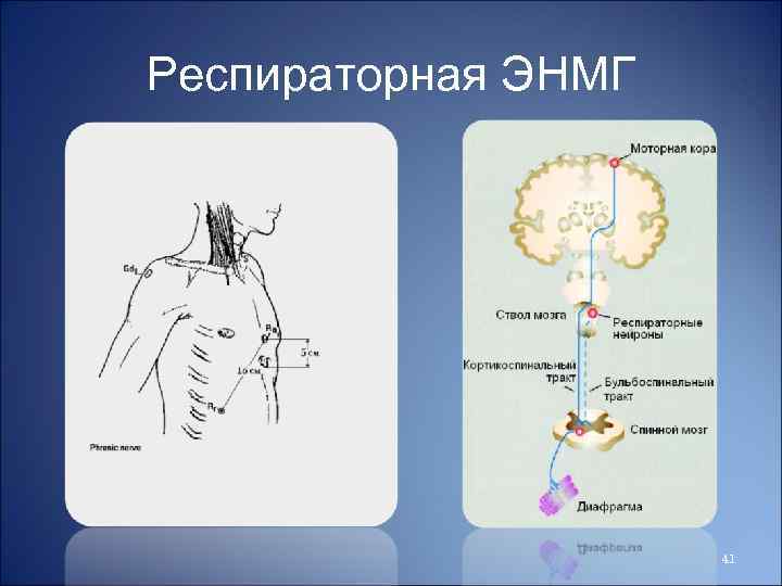 Респираторная ЭНМГ 41 