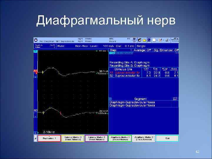 Диафрагмальный нерв 42 