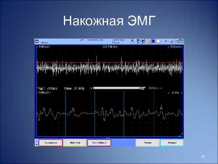 Накожная ЭМГ 43 