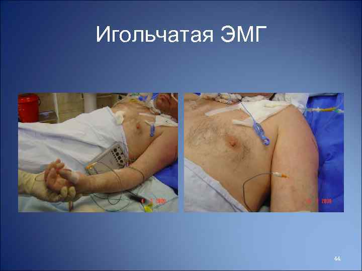 Игольчатая ЭМГ 44 