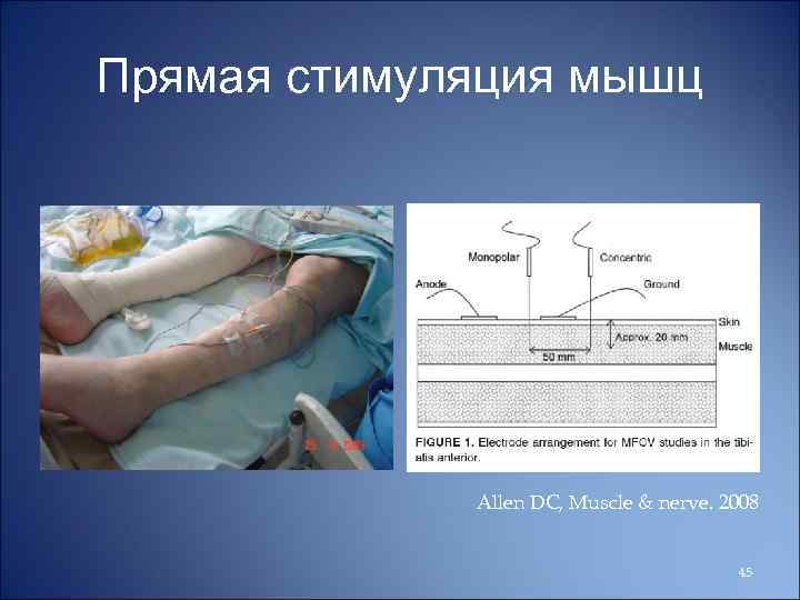 Прямая стимуляция мышц Allen DC, Muscle & nerve. 2008 45 