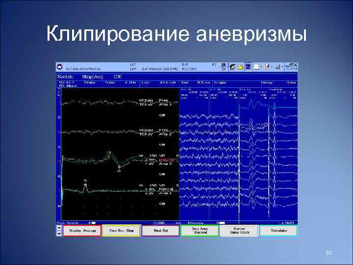 Клипирование аневризмы 51 