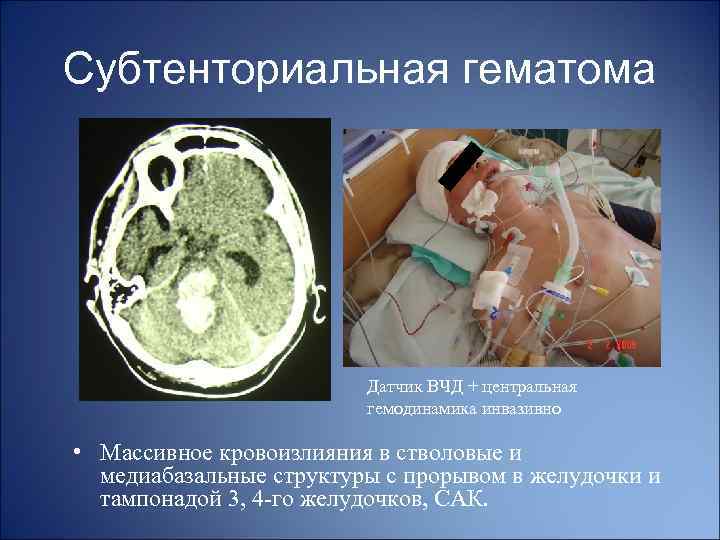 Субтенториальная гематома Датчик ВЧД + центральная гемодинамика инвазивно • Массивное кровоизлияния в стволовые и