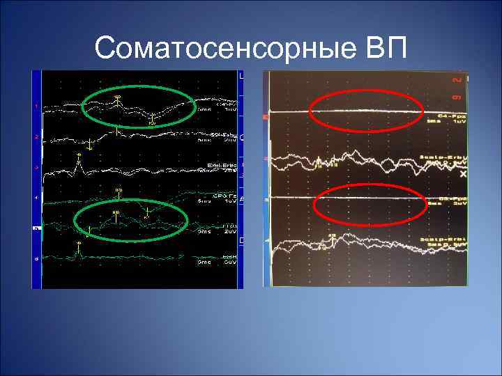 Соматосенсорные ВП Норма Пациент 