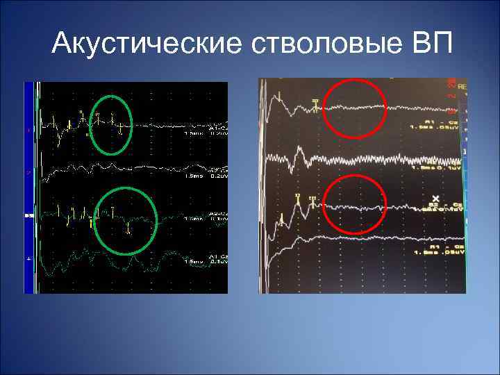 Акустические стволовые ВП Норма Пациент 