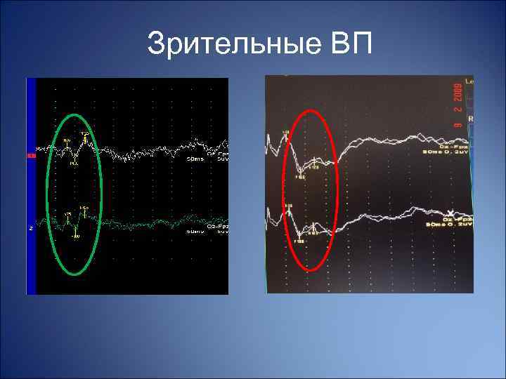 Зрительные ВП Норма Пациент 