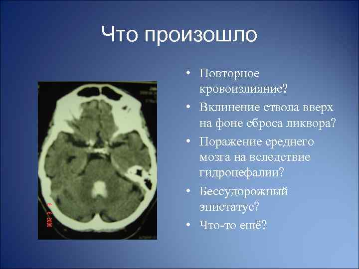 Что произошло • Повторное кровоизлияние? • Вклинение ствола вверх на фоне сброса ликвора? •