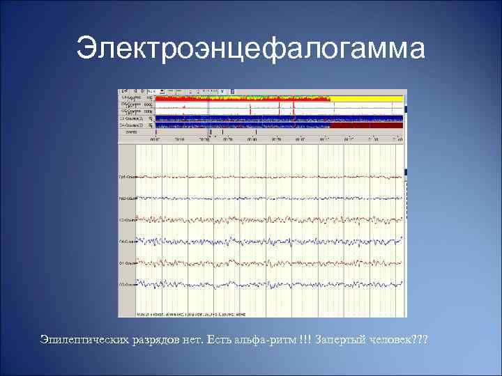 Электроэнцефалогамма Эпилептических разрядов нет. Есть альфа-ритм !!! Запертый человек? ? ? 