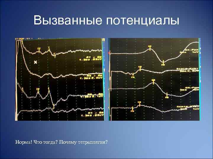 Вызванные потенциалы Норма! Что тогда? Почему тетраплегия? 