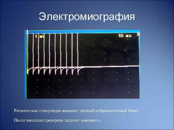 Электромиография Ритмическая стимуляция выявляет полный нейромышечный блок! После введения прозерина пациент «оживает» . 