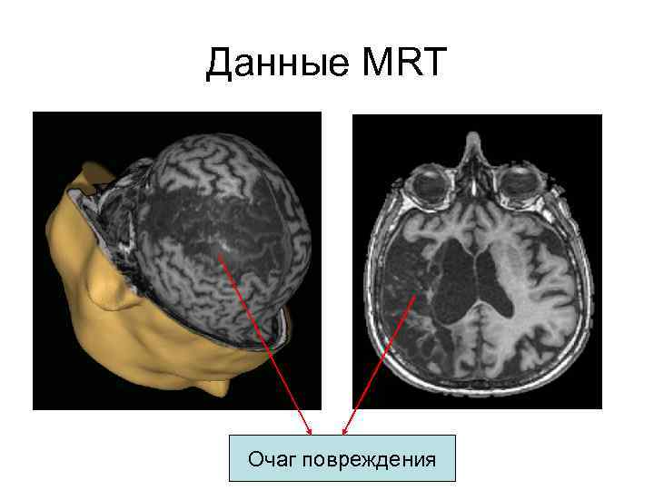 Данные MRT Очаг повреждения 