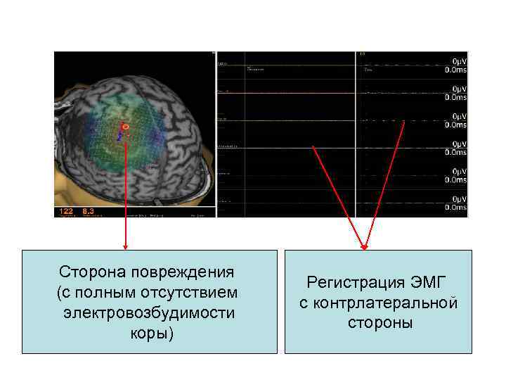 Сторона повреждения (с полным отсутствием электровозбудимости коры) Регистрация ЭМГ с контрлатеральной стороны 