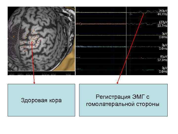 Здоровая кора Регистрация ЭМГ с гомолатеральной стороны 