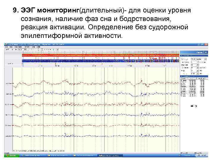 9. ЭЭГ мониторинг(длительный)- для оценки уровня сознания, наличие фаз сна и бодрствования, реакция активации.