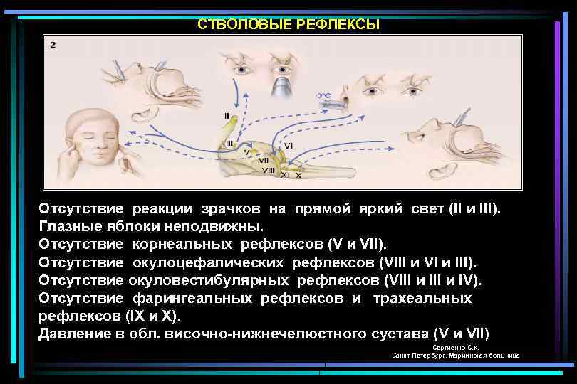 СТВОЛОВЫЕ РЕФЛЕКСЫ Отсутствие реакции зрачков на прямой яркий свет (II и III). Глазные яблоки