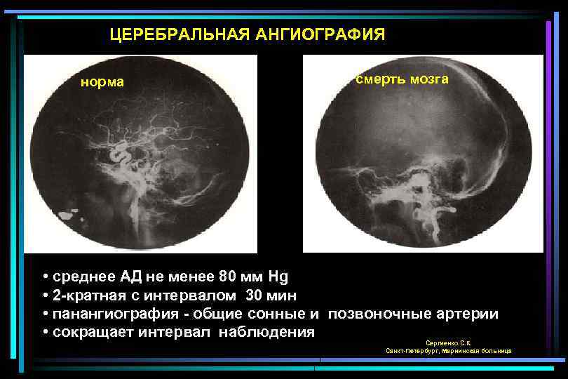 Умирающий мозг. Ангиография смерть мозга. Церебральная ангиография при смерти мозга. Смерть головного мозга понятие.