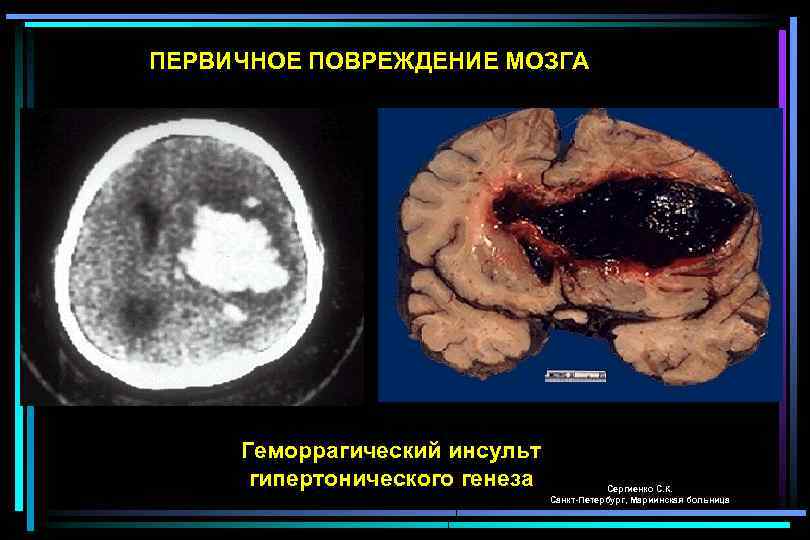ПЕРВИЧНОЕ ПОВРЕЖДЕНИЕ МОЗГА Геморрагический инсульт гипертонического генеза Сергиенко С. К. Санкт-Петербург, Мариинская больница 