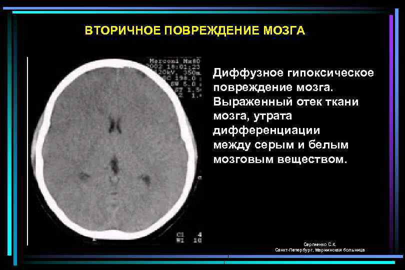 ВТОРИЧНОЕ ПОВРЕЖДЕНИЕ МОЗГА Диффузное гипоксическое повреждение мозга. Выраженный отек ткани мозга, утрата дифференциации между