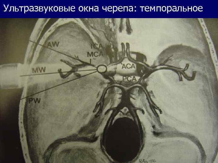 Ультразвуковые окна черепа: темпоральное 