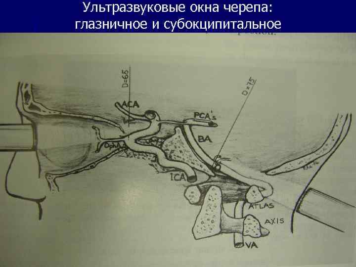 Ультразвуковые окна черепа: глазничное и субокципитальное 