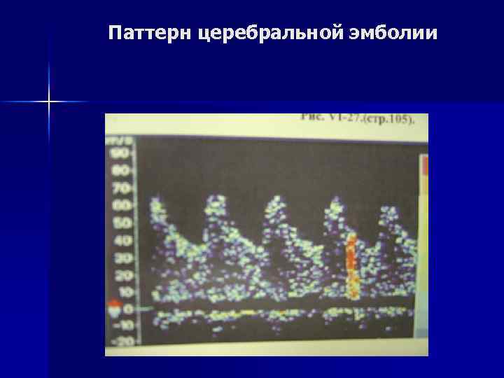 Паттерн церебральной эмболии 