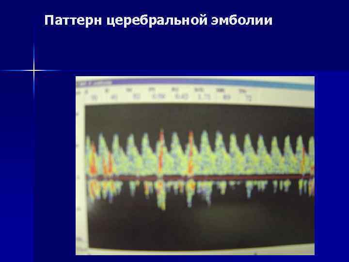 Паттерн церебральной эмболии 