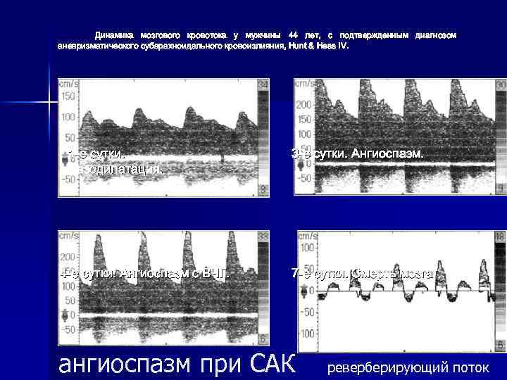 Динамика мозгового кровотока у мужчины 44 лет, с подтвержденным диагнозом аневризматического субарахноидального кровоизлияния, Hunt