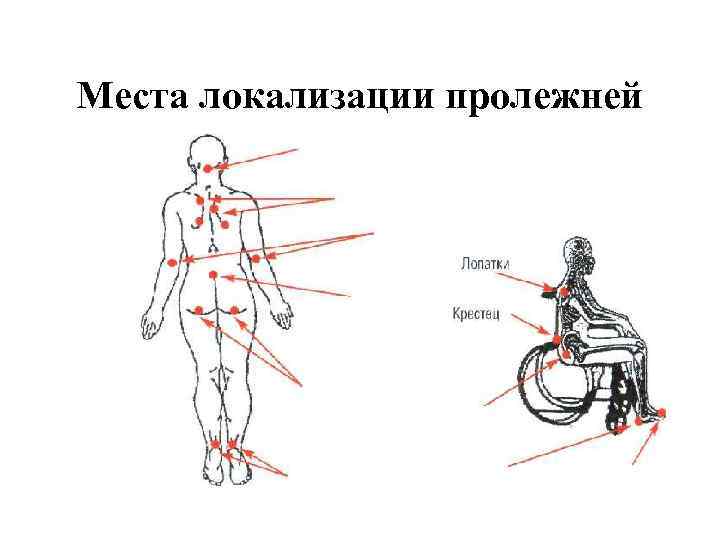 Места локализации пролежней 