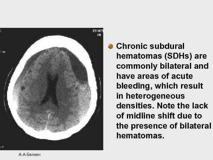 Chronic subdural hematomas (SDHs) are commonly bilateral and have areas of acute bleeding, which