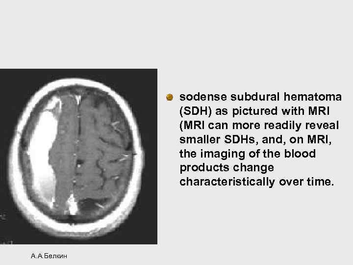 sodense subdural hematoma (SDH) as pictured with MRI (MRI can more readily reveal smaller