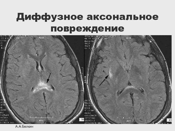 Диффузное аксональное повреждение А. А. Белкин 