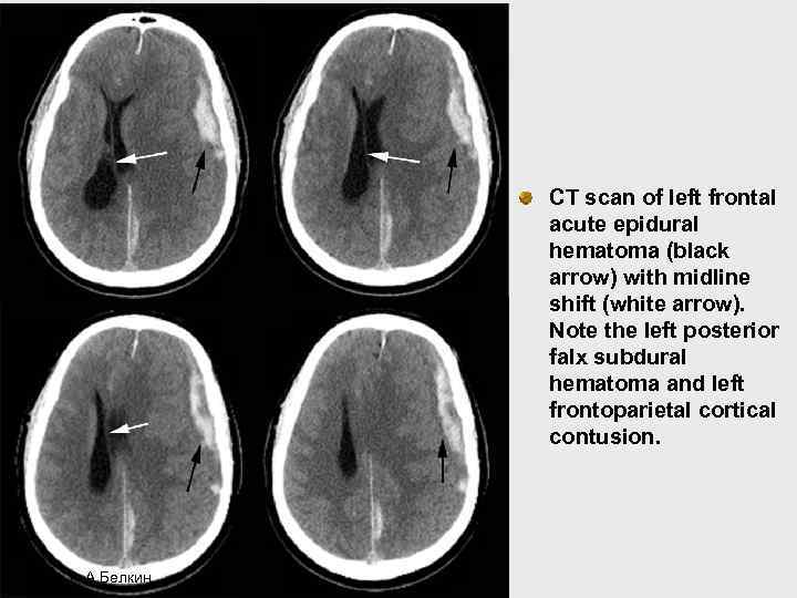 CT scan of left frontal acute epidural hematoma (black arrow) with midline shift (white