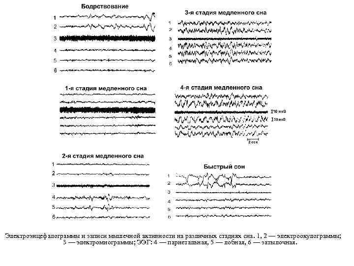 Электроэнцефалограммы и записи мышечной активности на различных стадиях сна. 1, 2 — электроокулограммы; 3